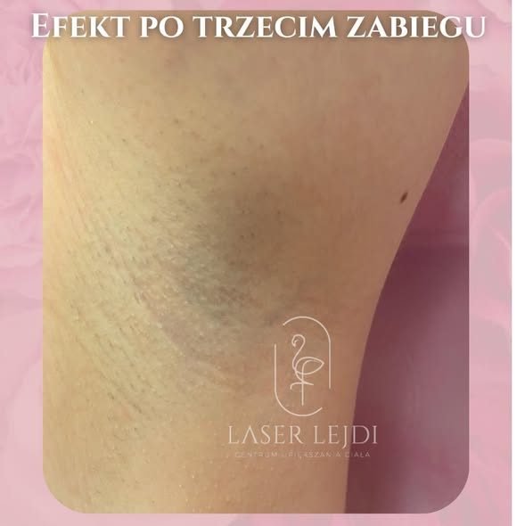 Pachy po trzecim zabiegu depilacji laserowej