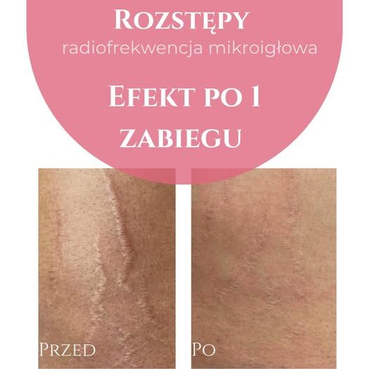 Rozstępy — efekt po zabiegu RF mikroigłowa