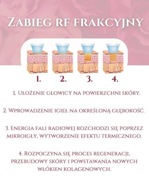 Schemat zabiegu RF frakcyjnego krok po kroku